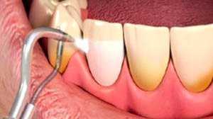 điều trị nha chu và cạo vôi răng tại phòng khám nha khoa răng hàm mặt Ngọc Anh