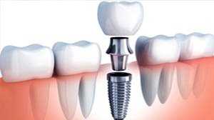 dịch vu cấy ghép implant tại phòng khám nha khoa uy tin chuyên răng hàm mặt Ngọc Anh