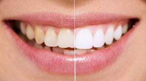 dịch vụ nha khoa tẩy trắng răng tại nha khoa uy tín Ngọc Anh