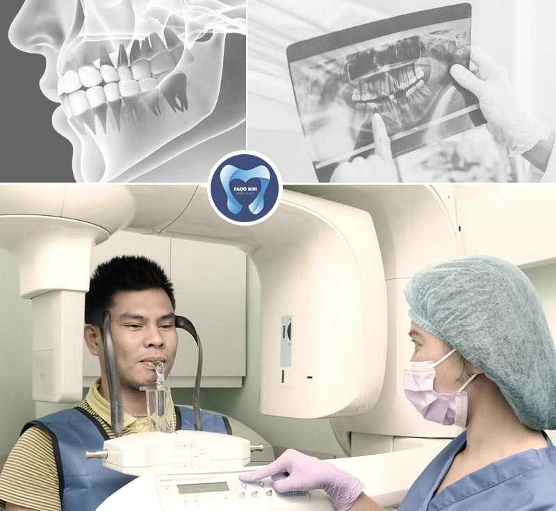 Trồng răng Implant giá bao nhiêu